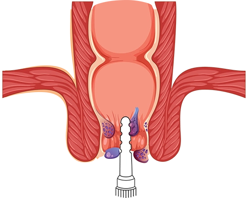 Diagrama anatómico que muestra cómo actúa Hemopropin® en las hemorroides