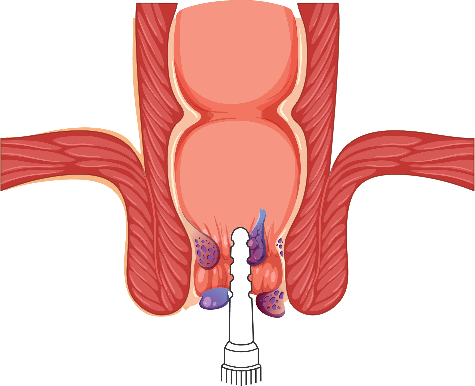 hemorroides-aplicador-crema-hemopropin